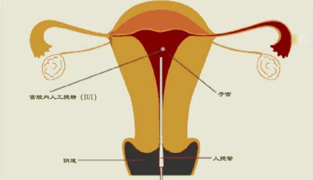 孕期焦虑抑郁情绪